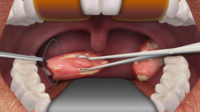 Cpt code for biopsy of tonsil