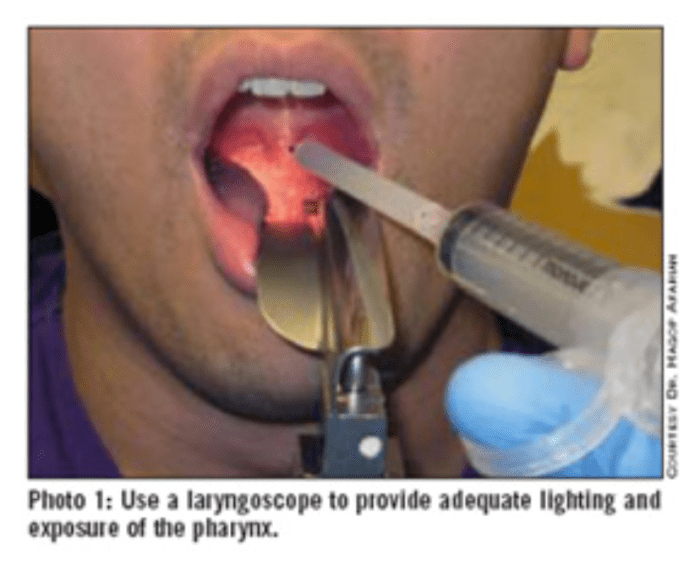 Cpt code for biopsy of tonsil